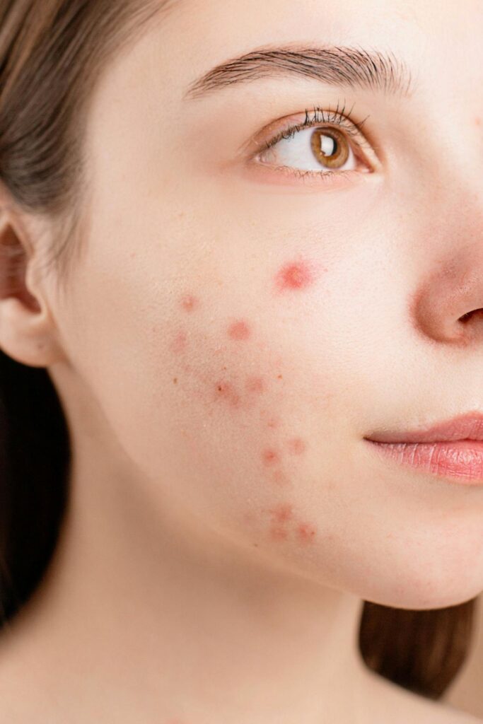 acne treatment in lucknow