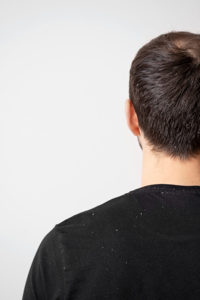 Man with visible white dandruff flakes on black shirt showing mild scalp flaking