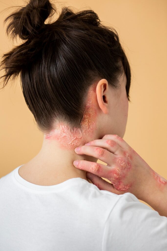 Red scaly patches along hairline and neck typical of scalp psoriasis