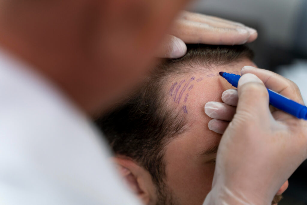 Dermatologist marking a patient's scalp before a hair transplant consultation in Lucknow
