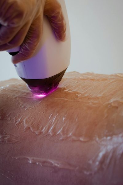 laser hair removal in lucknow