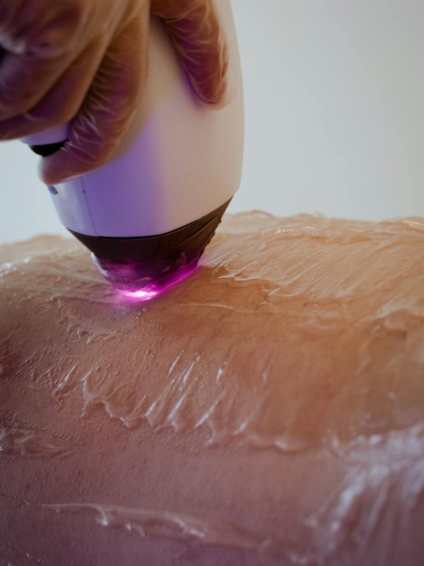 laser hair removal in lucknow