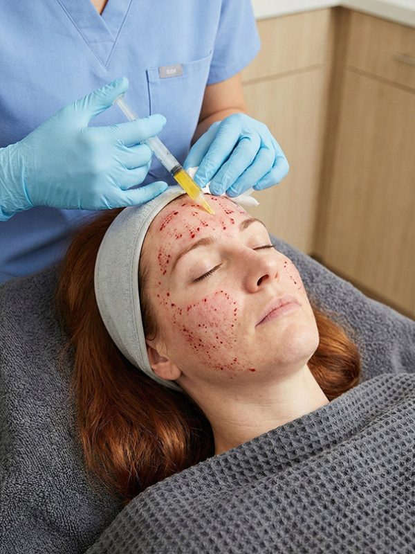 Indian female patient undergoing a PRP vampire facial treatment to improve skin texture, showing a professional injection procedure on the forehead.